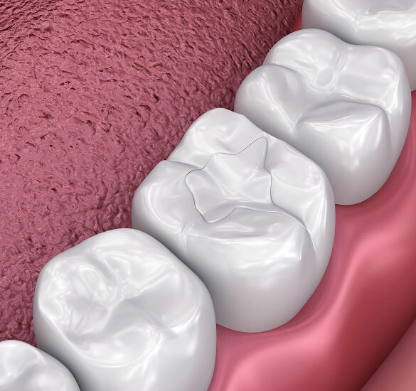 Dental Sealants